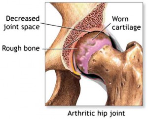 hip-joint-pain (1)