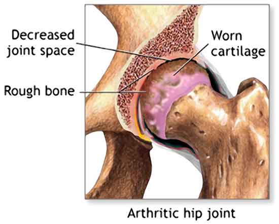 Ladies, Do You Feel Pain Below Your Hip Joints?