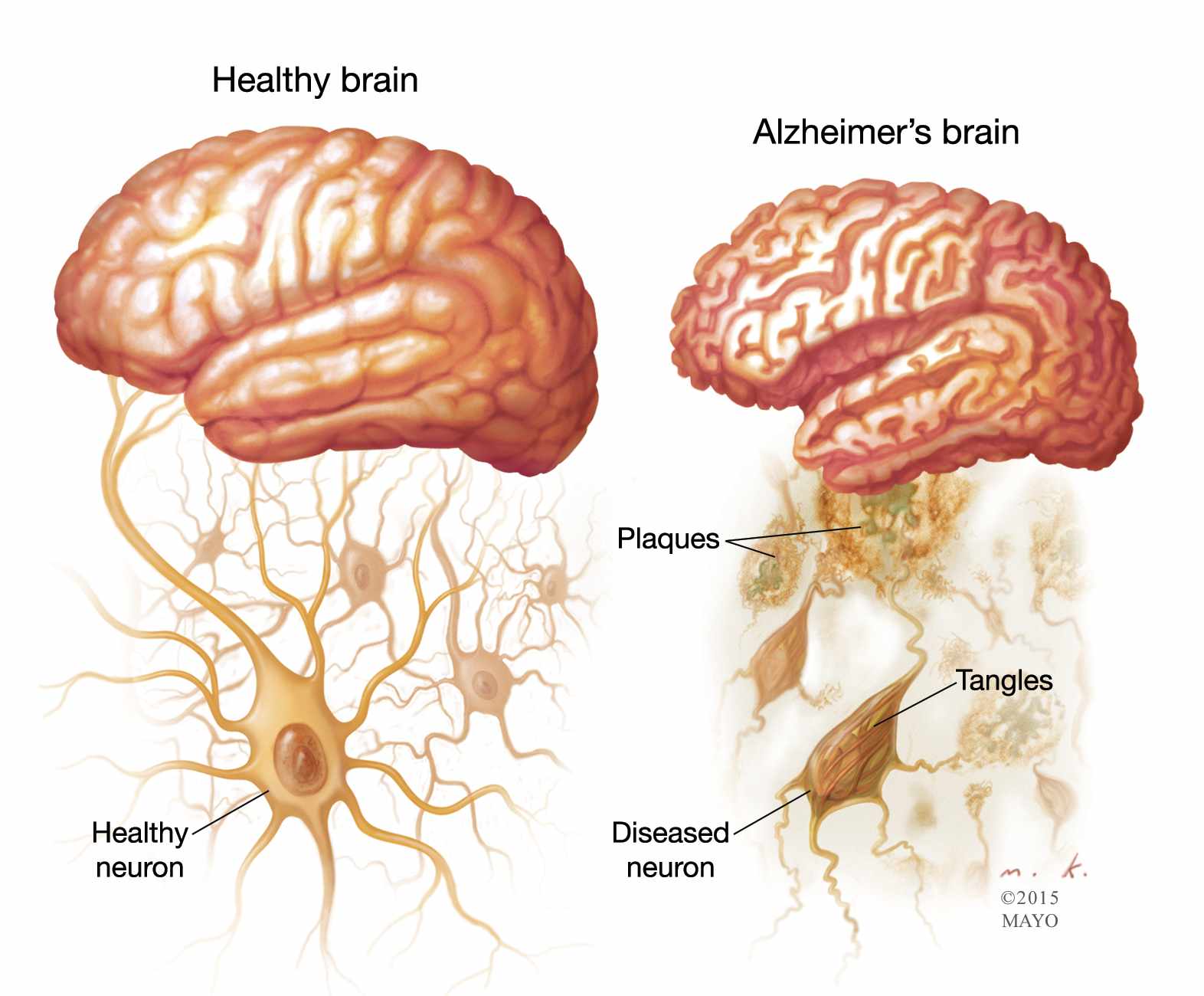 Early Sign of Alzheimer’s Disease – Decreased Sense of Smell?