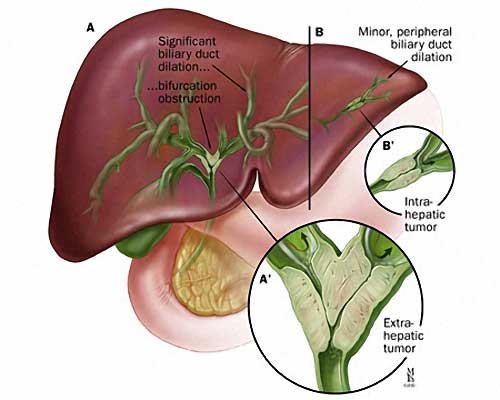 A Risk Factor for Cholangiocarcinoma (Bile Duct Cancer)