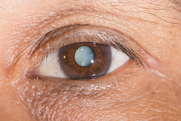 Have Sleep Problems? You May Have a Cataract…Here’s Why