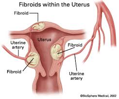 Uterine Fibroids: What You Should Know
