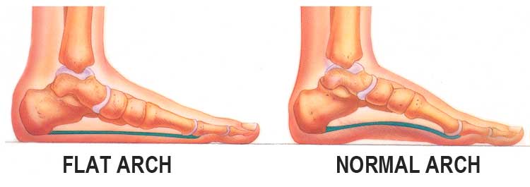 Health Risks of Flat Feet and How You Can Prevent It