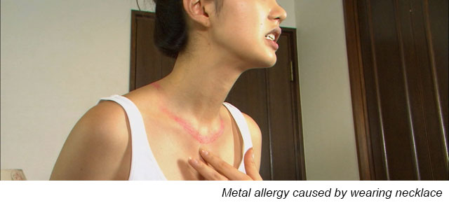 The Hidden Cause of Nickel Metal Allergy Revealed