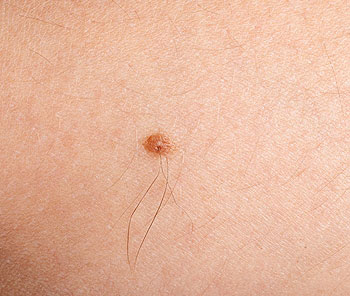 How to Tell if a Mole Is Cancerous or Not