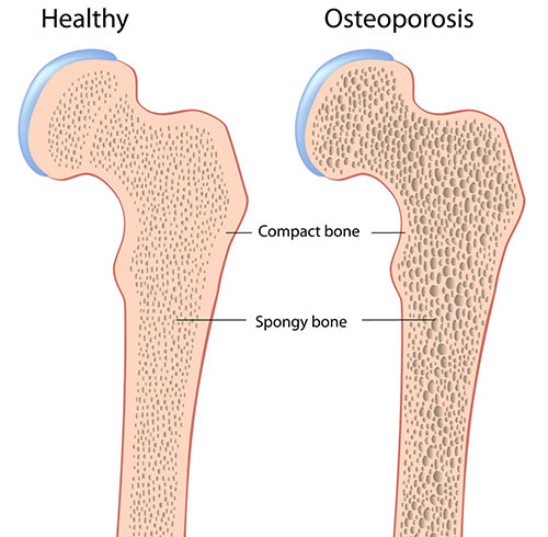 Osteoporosis in Your 30’s? How to Prevent It Naturally