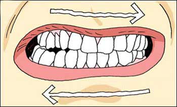 What You Should Know About Teeth Grinding (Bruxism)