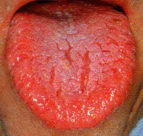 Color of Your Tongue Can Reveal Early Signs of Disease